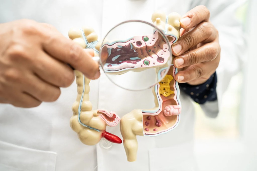 Der ständige Blähbauch: Ist es Reizdarm oder doch SIBO?